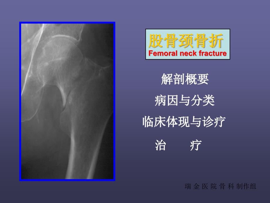 股骨颈骨折医学课件_第1页