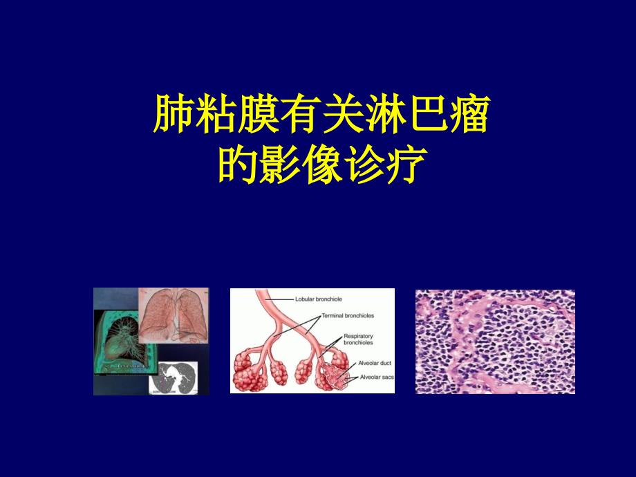 肺粘膜相关淋巴瘤的影像学诊疗_第1页