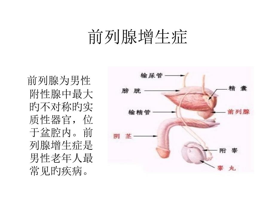 前列腺增生症_第1页