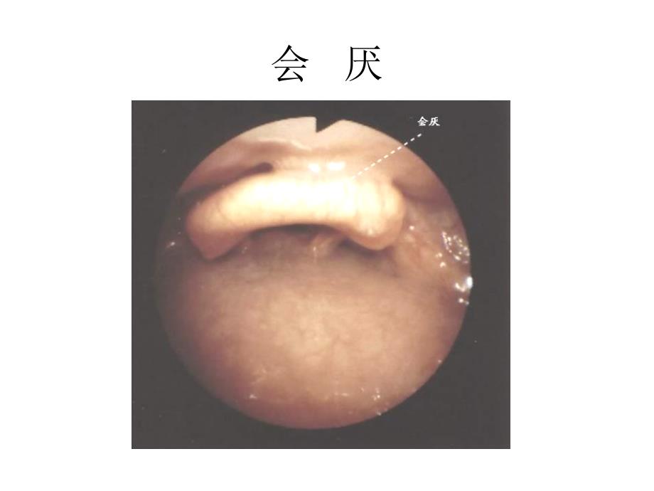 纤维支气管镜解剖_第1页