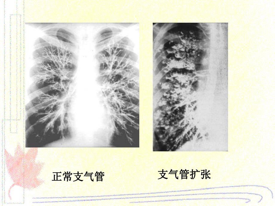 支气管扩张医学知识宣讲_第1页