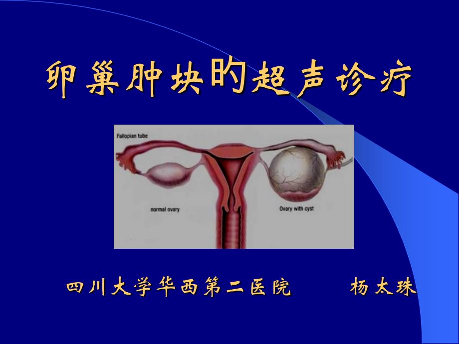 卵巢肿块的超声诊疗_第1页