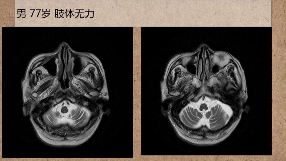 橄榄桥脑小脑萎缩的影像学诊断_第1页