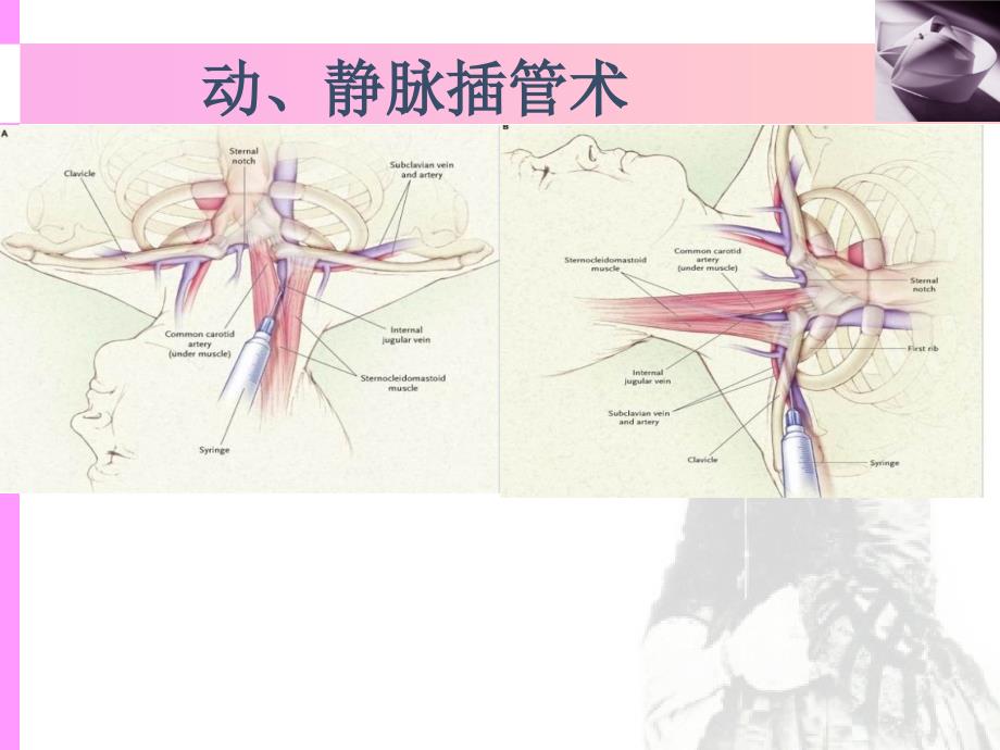 动静脉插管术_第1页