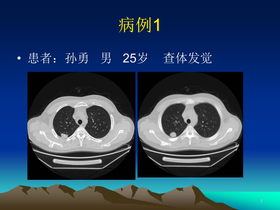 肺错构瘤影像表现专家讲座_第1页