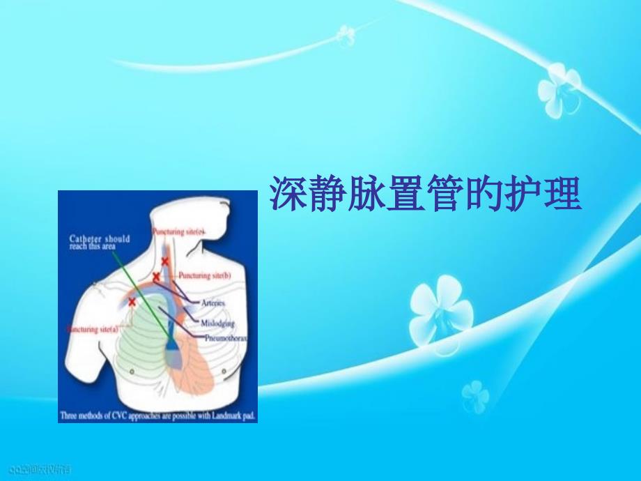 深静脉置管的护理_第1页