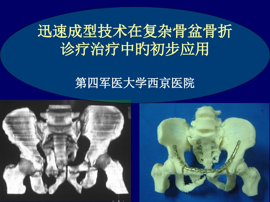 快速成型技术在复杂骨盆骨折诊断治疗中的初步应用_第1页