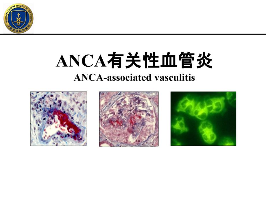 ANCA相关性血管炎专业资料医学资料_第1页