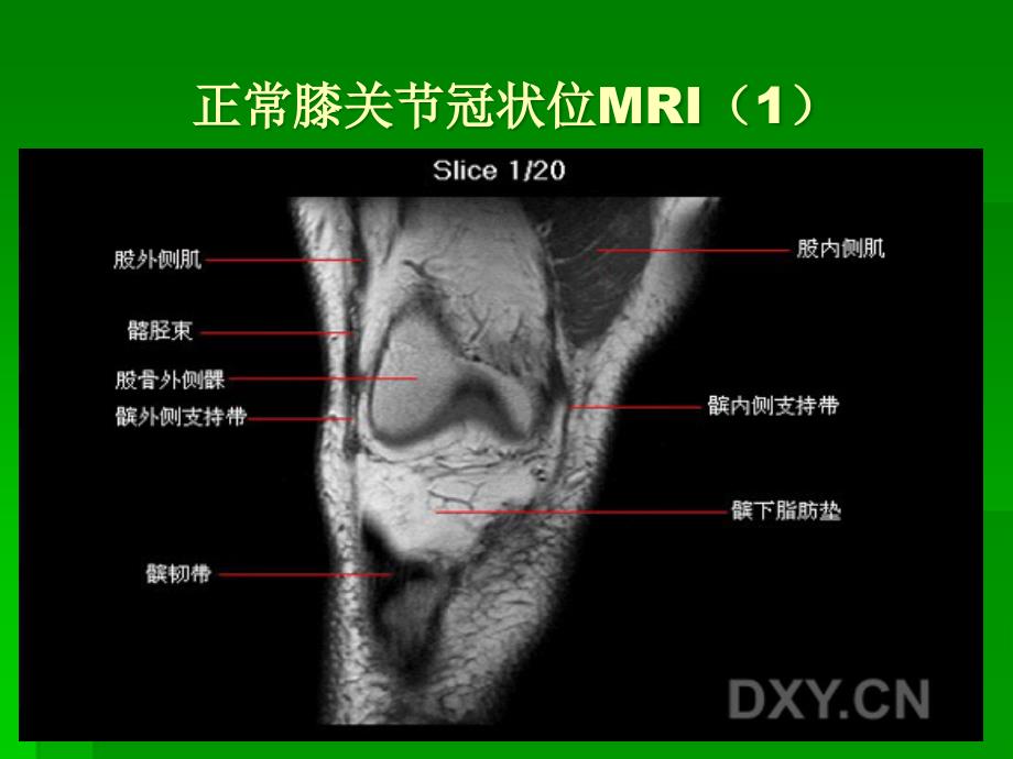 膝关节MRI解剖专题知识_第1页