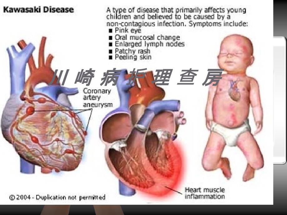 川崎病的护理查房_第1页