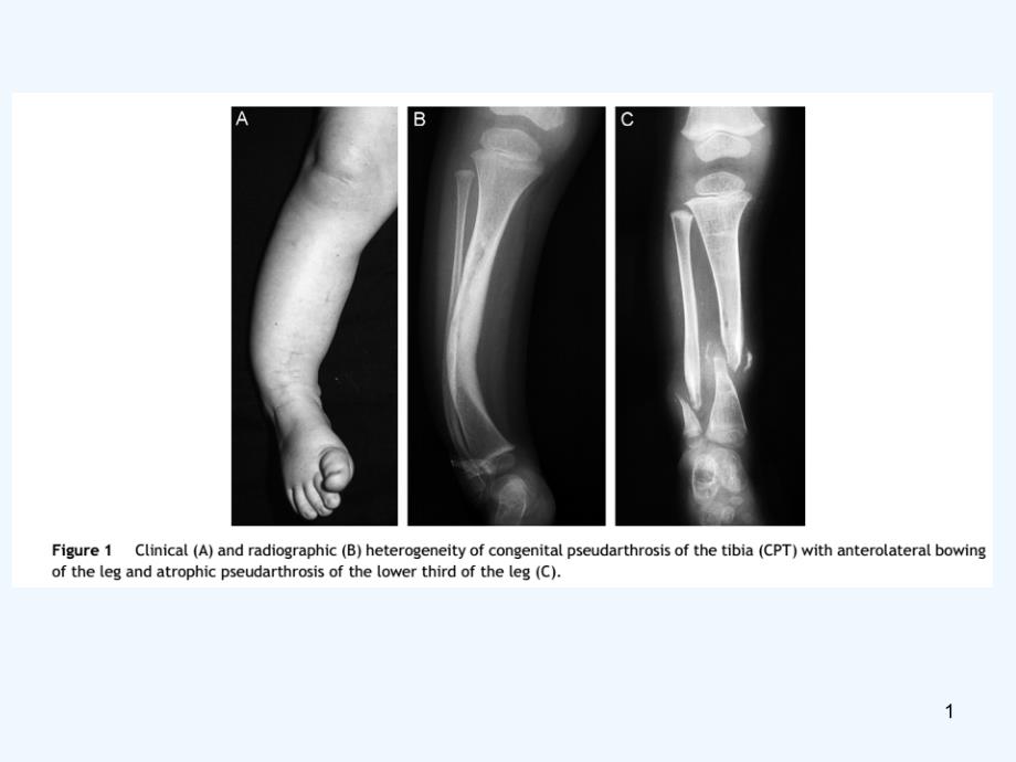 先天性胫骨假关节-PPT_第1页