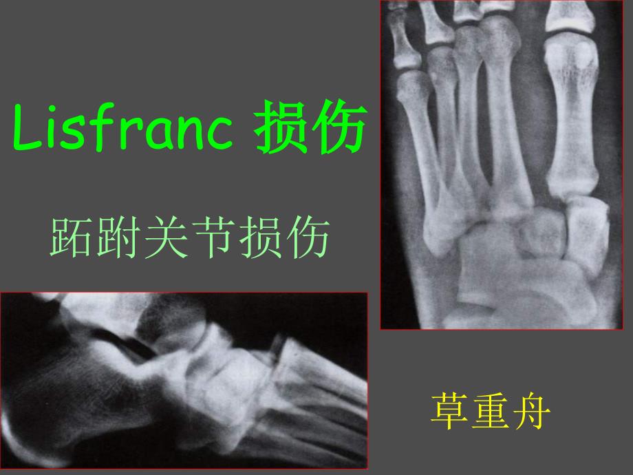 Lisfrance关节损伤专题知识_第1页