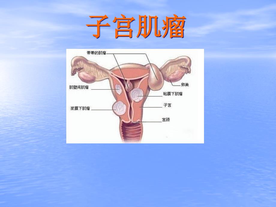 子宫肌瘤专业医学知识宣讲_第1页