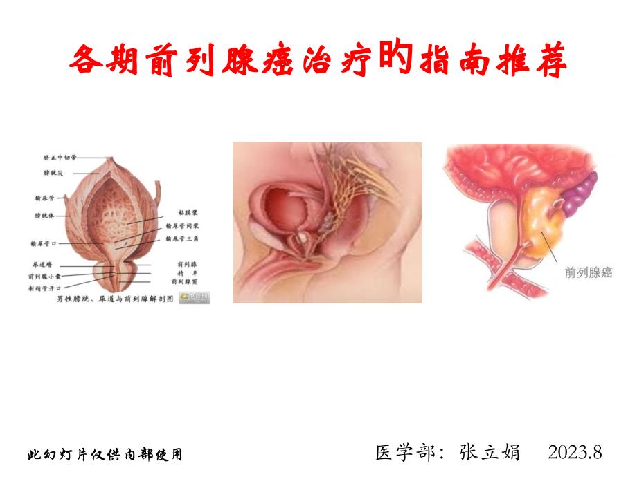 各期前列腺癌治疗的指南推荐_第1页