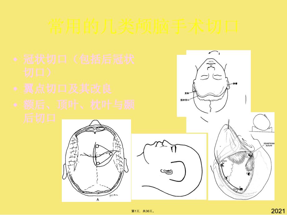 颅脑手术切口的设计原则(与“肿瘤”有关文档共36张)_第1页