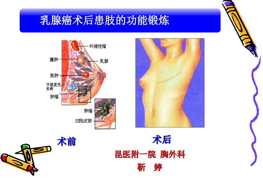 乳腺癌术后的功能锻炼课件_第1页