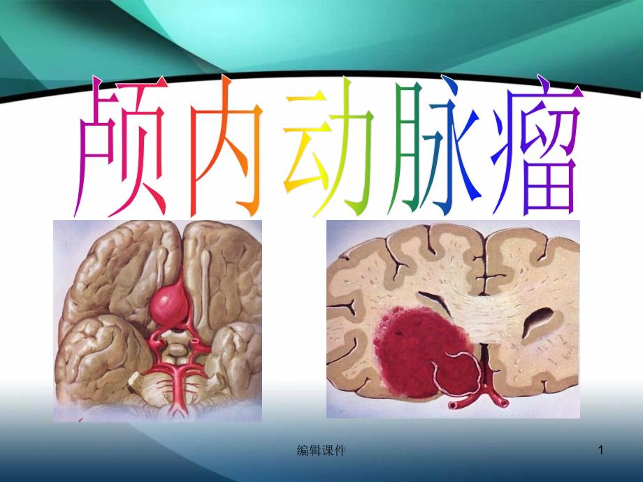 颅内动脉瘤介入术后的护理课件_第1页