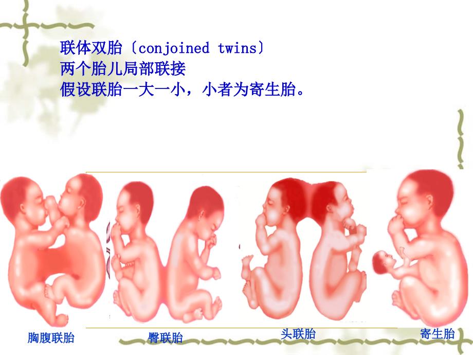 联体双胎-妇产_第1页