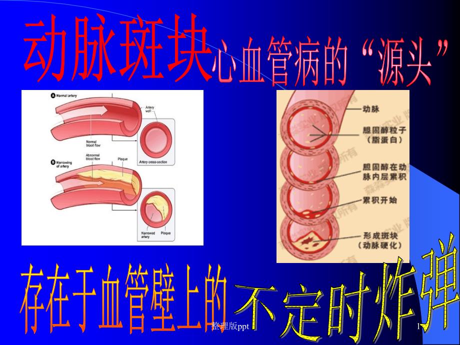 颈动脉斑块专题课件_第1页