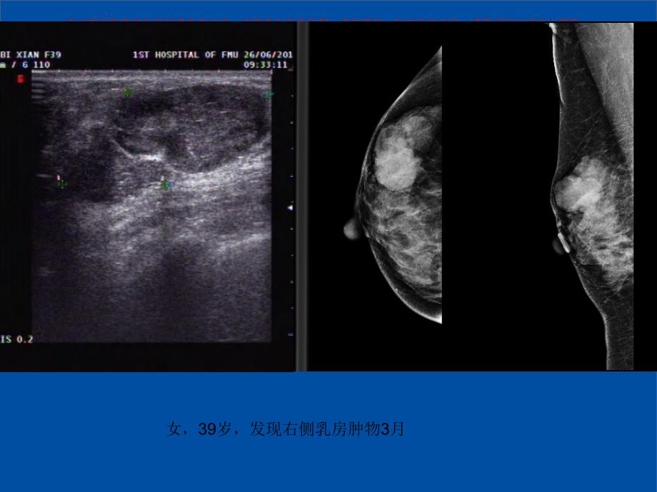 乳腺叶状肿瘤影像表现培训课件_第1页