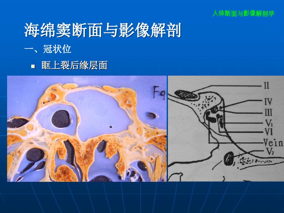 海绵窦断面与影像解剖课件_第1页