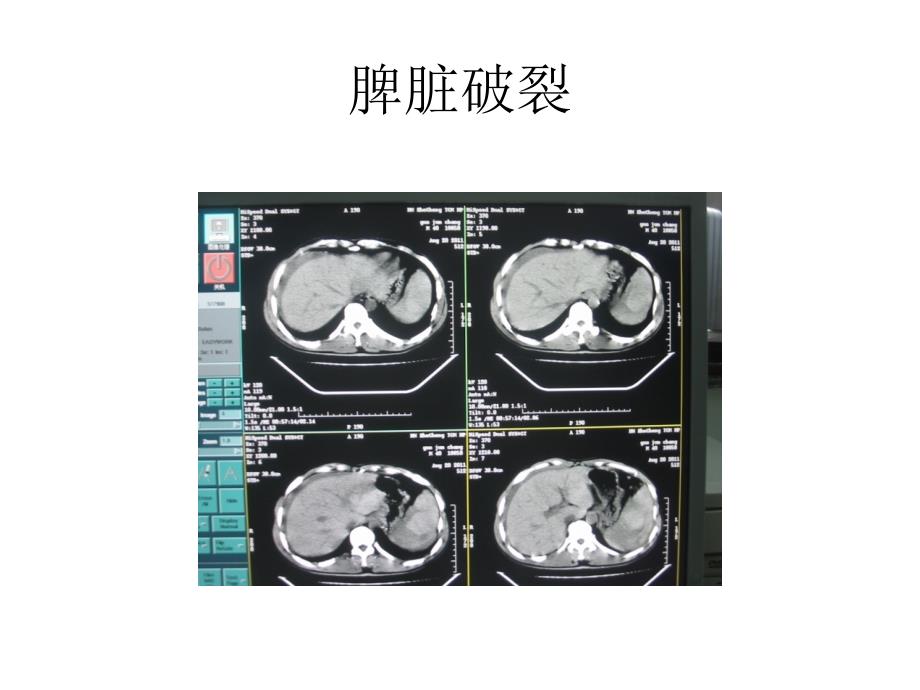 肝脏病例图片课件_第1页